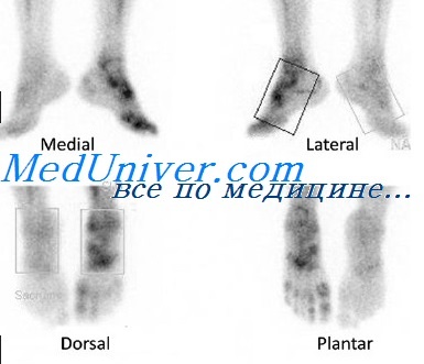 Сцинтиграфия костей скелета при переломах thumbnail
