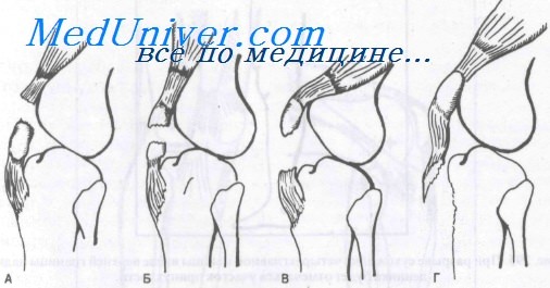 Синдром верхнего и нижнего полюса надколенника thumbnail