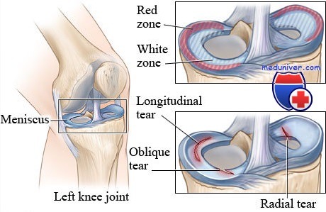 травма мениска коленного сустава