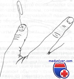 Перелом дистальной фаланги пальца руки симптомы thumbnail