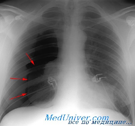 Рентгеновский снимок с просветлением правого легочного поля при пневмотораксе