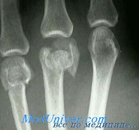 рентгенограмма пястных костей