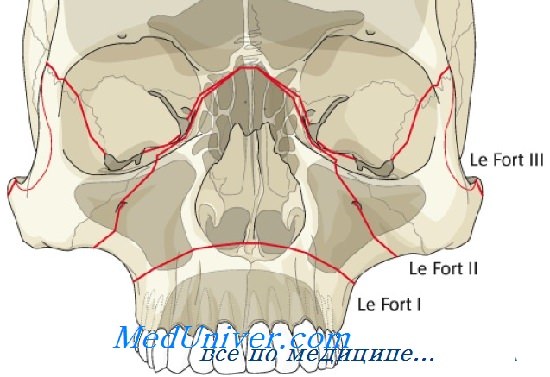 перелом верхней челюсти