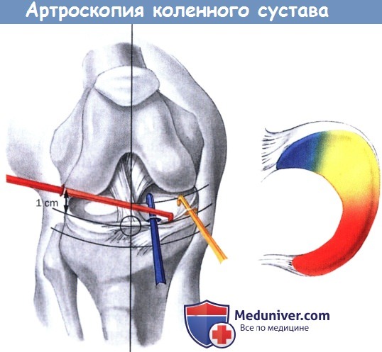 Доступ при артроскопии коленного сустава