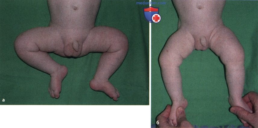 Детский кортикальный гиперостоз (болезнь Каффи)