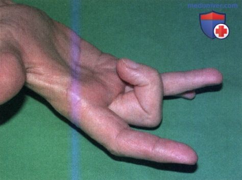 Щелкающий (пружинящий) палец