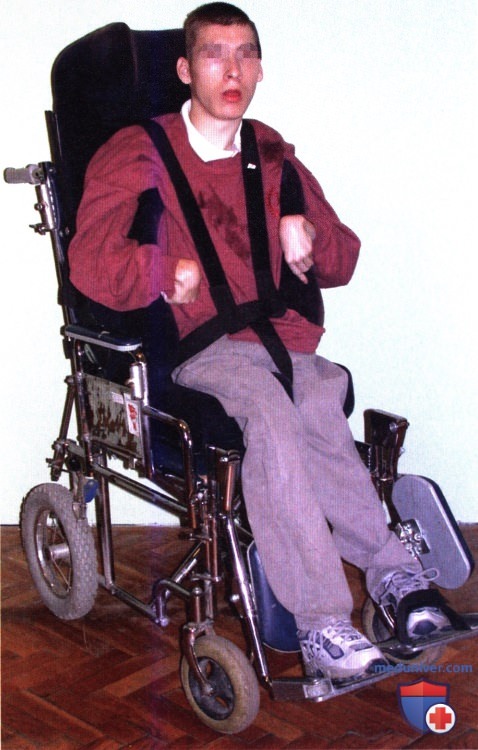 Детский церебральный паралич (ДЦП)