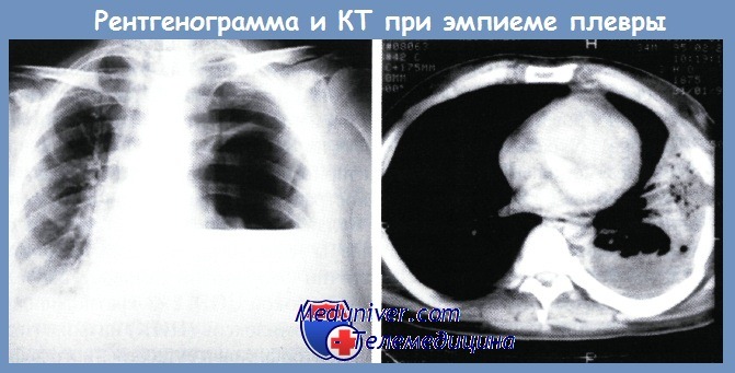 рентгенография и КТ при эмпиеме плевры