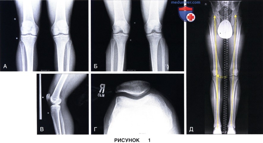 Показания и подготовка к дистальной остеотомии бедра коленного сустава