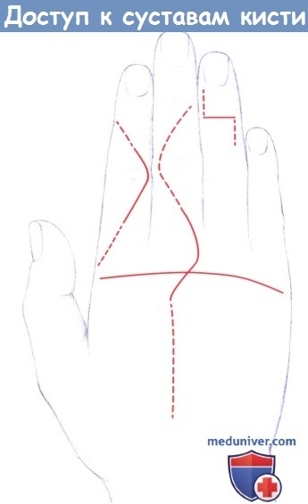 Техника дорсального доступа к пястно-фаланговому суставу кисти