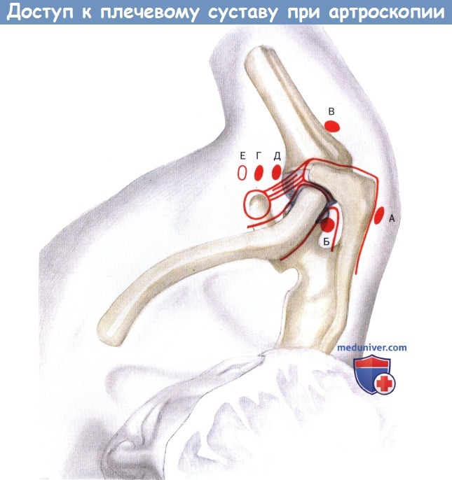Доступ к плечевому суставу при артроскопии