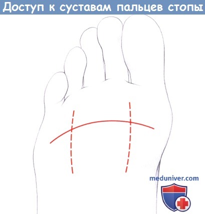 Разрез для доступа к суставам пальцев стопы