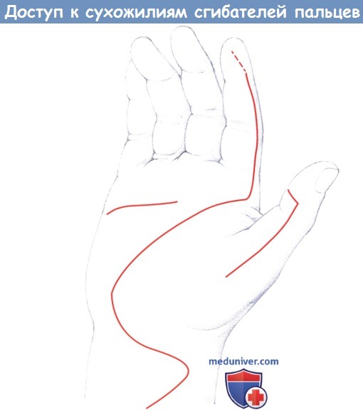 Доступ к сухожилиям сгибателей пальцев кисти