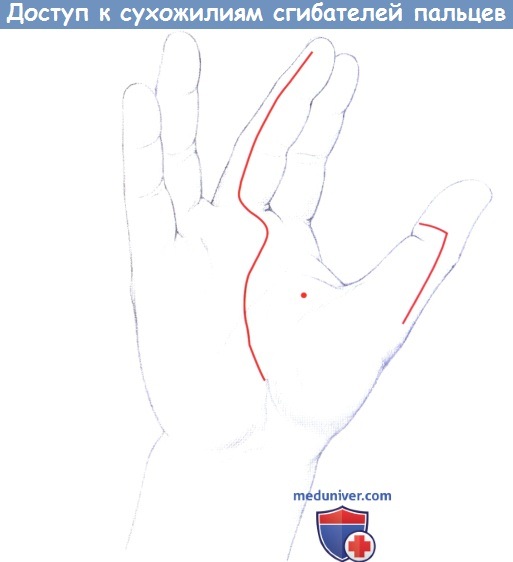 Доступ к сухожилиям сгибателей пальцев кисти