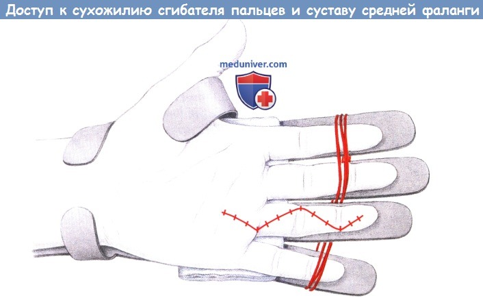Доступ к сухожилиям сгибателя и средней фаланге пальца кисти
