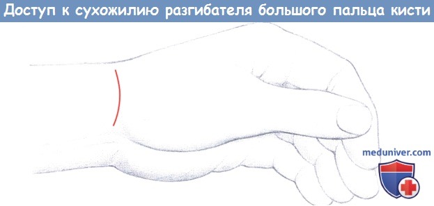 Доступ к сухожилию разгибателя первого (большого) пальца кисти