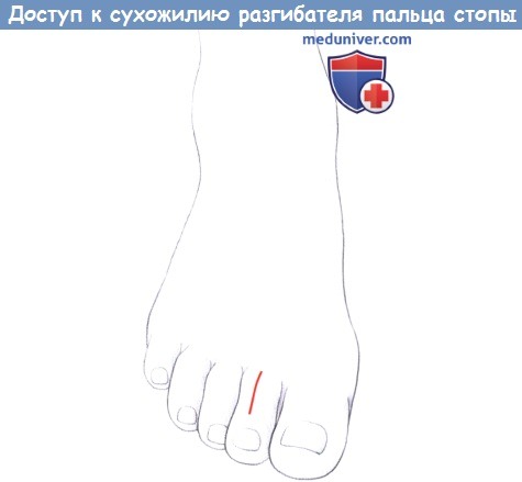Доступ к сухожилию разгибателя пальца стопы