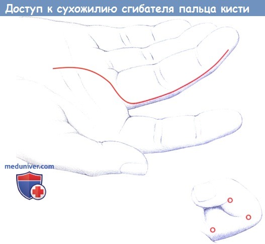 Доступ к сухожилию сгибателя пальца кисти через срединно-боковой разрез