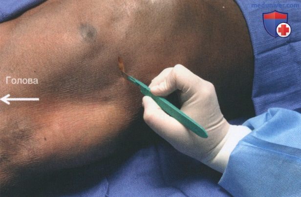 Операция дренирования плевральной полости (введения торакостомической трубки)