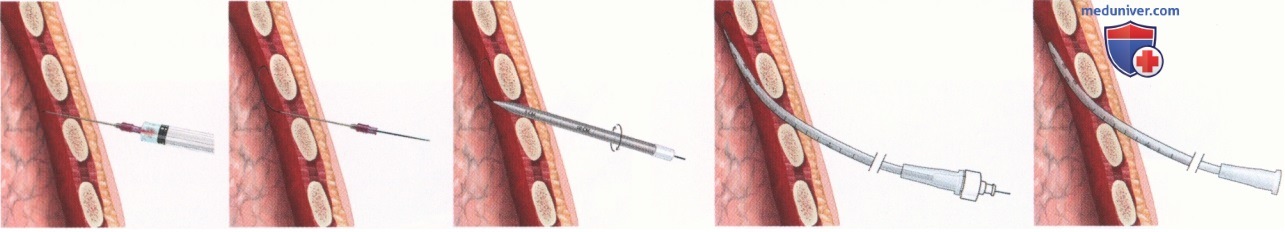Операция дренирования плевральной полости (введения торакостомической трубки)