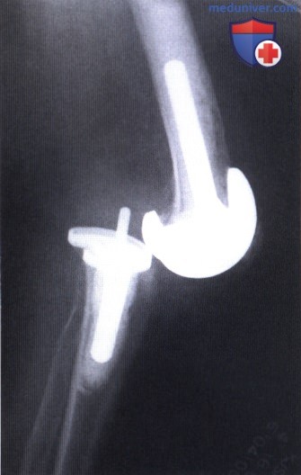 Показания, подготовка к эндопротезированию коленного сустава с сохранением задней крестообразной связки и заднестабилизированному эндопротезу