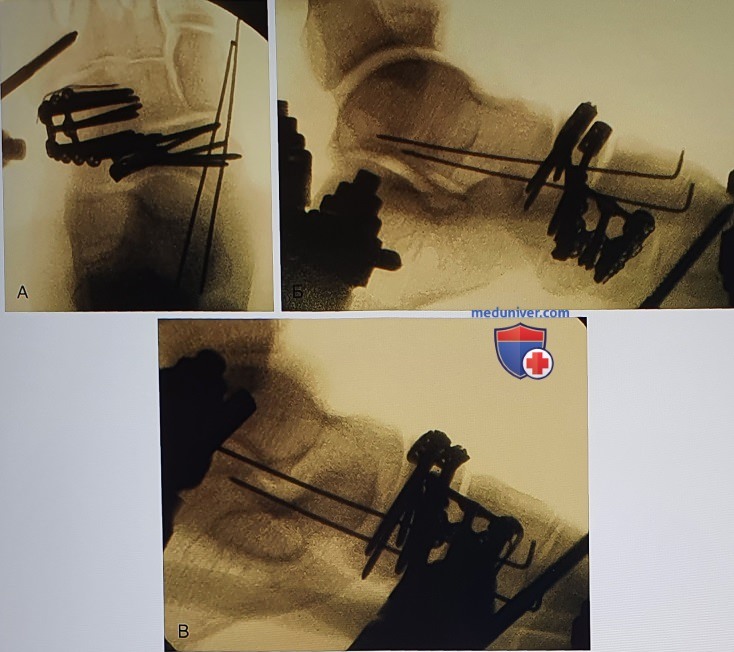 Открытая репозиция и внутренняя фиксация переломов ладьевидной, кубовидной костей