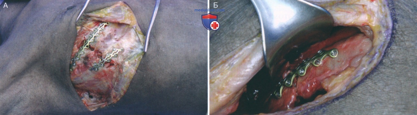 Техника, этапы операции по фиксации переломов ребер (остеосинтеза ребер)