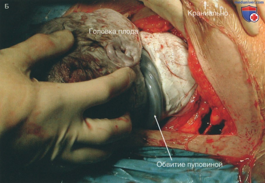Техника, этапы операции кесарево сечение при травме