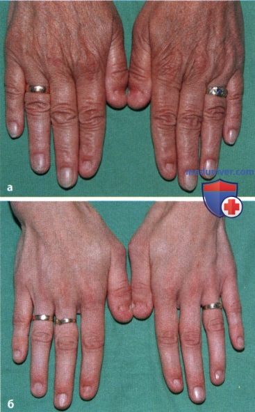 Костно-ногтевой дизостоз (ногтепателлярный синдром)