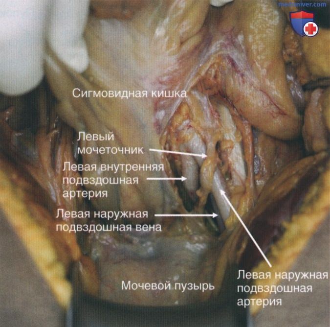 Хирургический контроль повреждений при кровотечении на фоне переломов костей таза