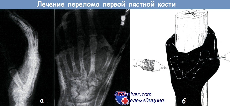 Пястная кость перелом разрабатывать пальцы thumbnail