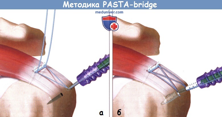  PASTA-bridge        