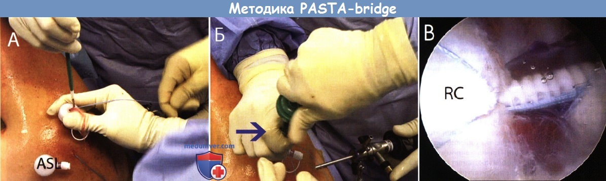  PASTA-bridge        