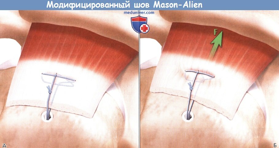          -   Mason-Alien