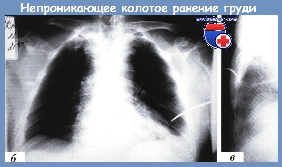 рентгенодиагностика непроникающего колотого ранения груди