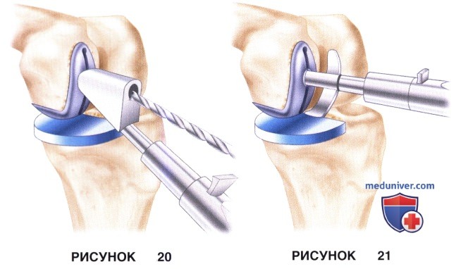 Доступ, техника одномыщелкового эндопротезирования коленного сустава