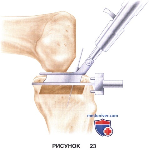 Доступ, техника одномыщелкового эндопротезирования коленного сустава