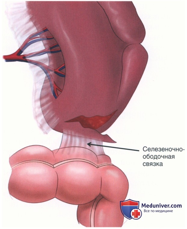 Техника, этапы операции при травме желудка, тонкой кишки, ободочной кишки, прямой кишки