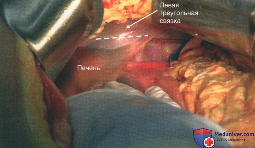 Техника, этапы операции при травме желудка, тонкой кишки, ободочной кишки, прямой кишки