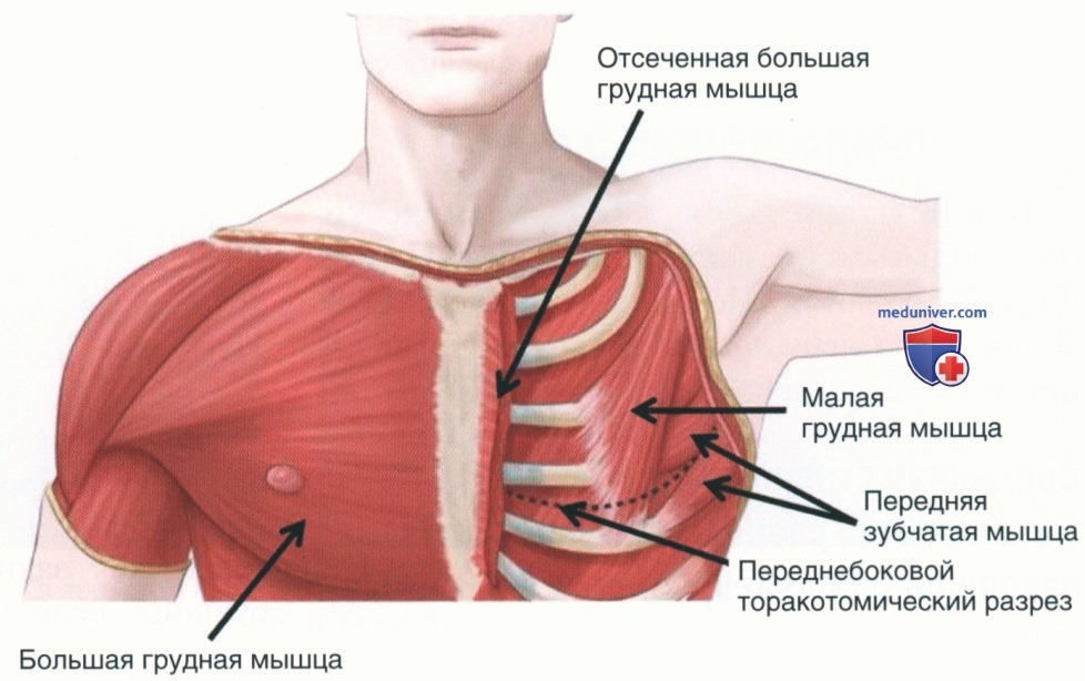 Принципы операций на грудной клетке при травмах