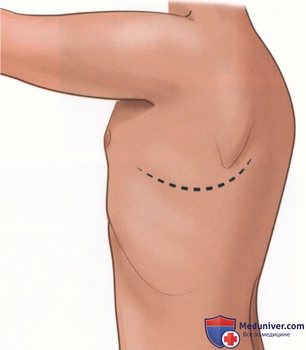 Принципы операций на грудной клетке при травмах