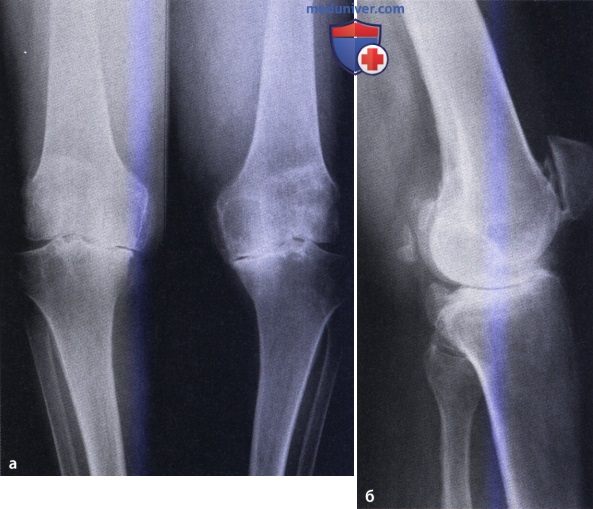 Первичный остеоартроз коленного сустава