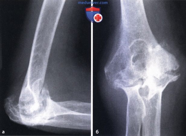 Первичный и вторичный остеоартроз локтевого сустава