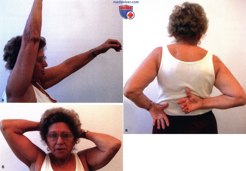 Первичный остеоартроз плечевого сустава