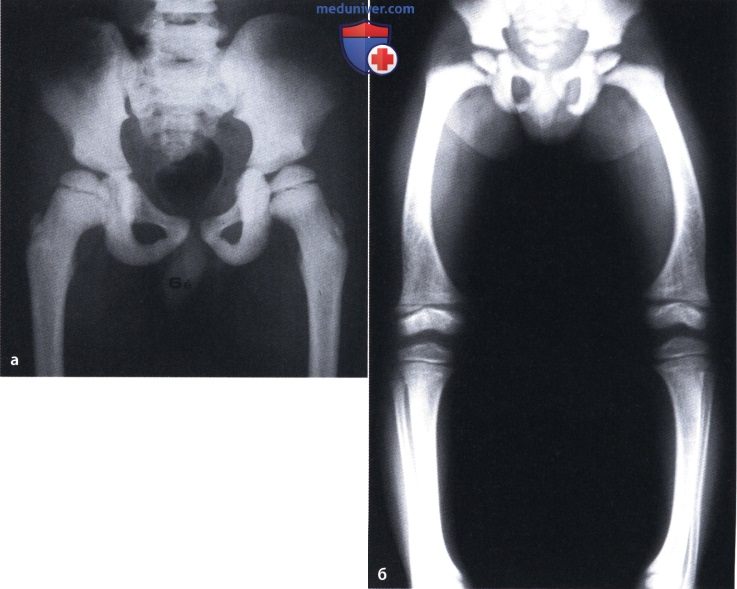 Остеопетроз (болезнь Альберс-Шёнберга, генерализованный врожденный остеосклероз, слоновые кости, мраморные кости, osteosclerosis fragilis generalisata)