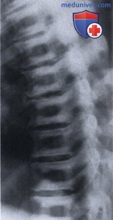 Остеопетроз (болезнь Альберс-Шёнберга, генерализованный врожденный остеосклероз, слоновые кости, мраморные кости, osteosclerosis fragilis generalisata)