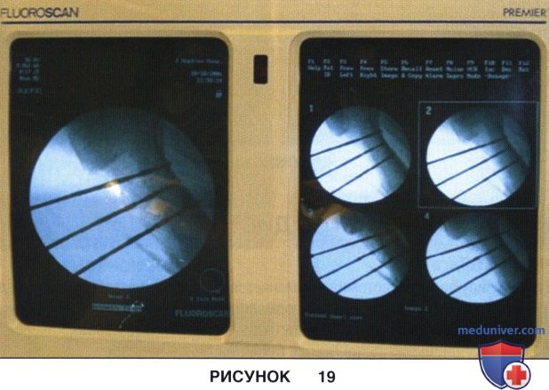 Доступ, техника остеотомии бугристости большеберцовой кости (антеромедиализации и дистализации)