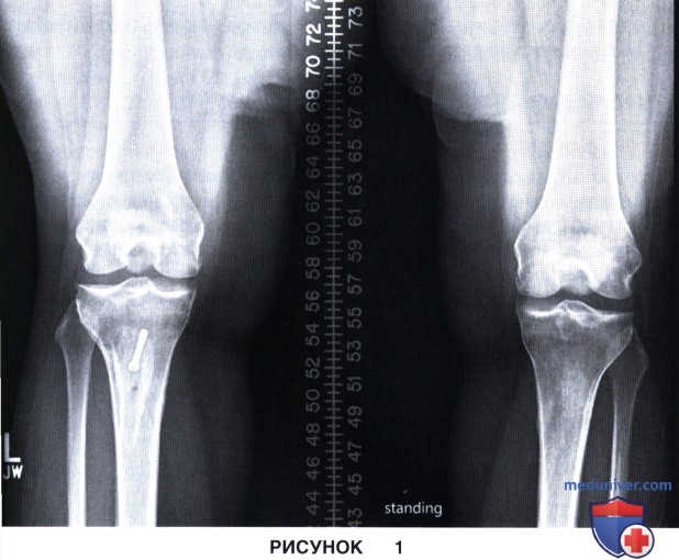 Показания и подготовка к остеохондральной аллотрансплантации в коленный сустав