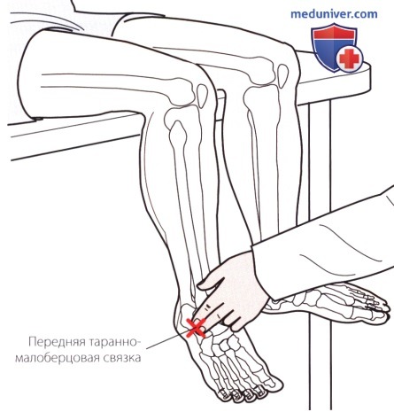 Пальпация голеностопного сустава и стопы снаружи (латеральной стороны)