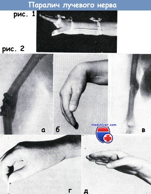 Повреждение лучевого нерва при переломе лучевой кости thumbnail